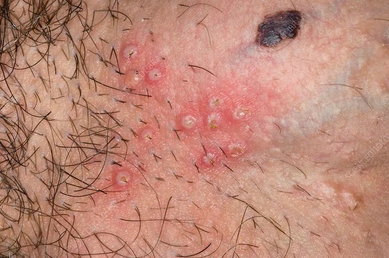 Genital herpes rash: painful blisters/ulcers (medical illustration)