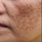 अनुहारको पोतो (Melasma) बाट हैरान हुनुहुन्छ? जान्नुहोस् यसको कारण, आधुनिक परीक्षण र उत्तम उपचार!