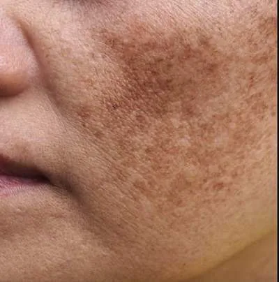 Melasma