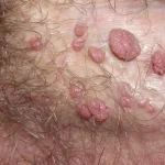Comprehensive Guide to HPV – Testing & Treatment : Derma Clinic Kathmandu