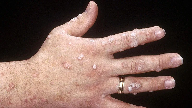 Warts in hand