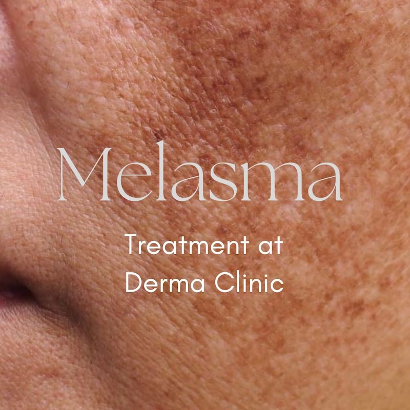 Melasma Treatment Derma Clinic