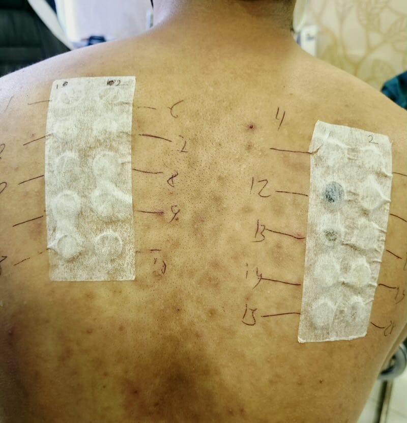 Skin Patch Testing At Derma Clinic Kathmandu