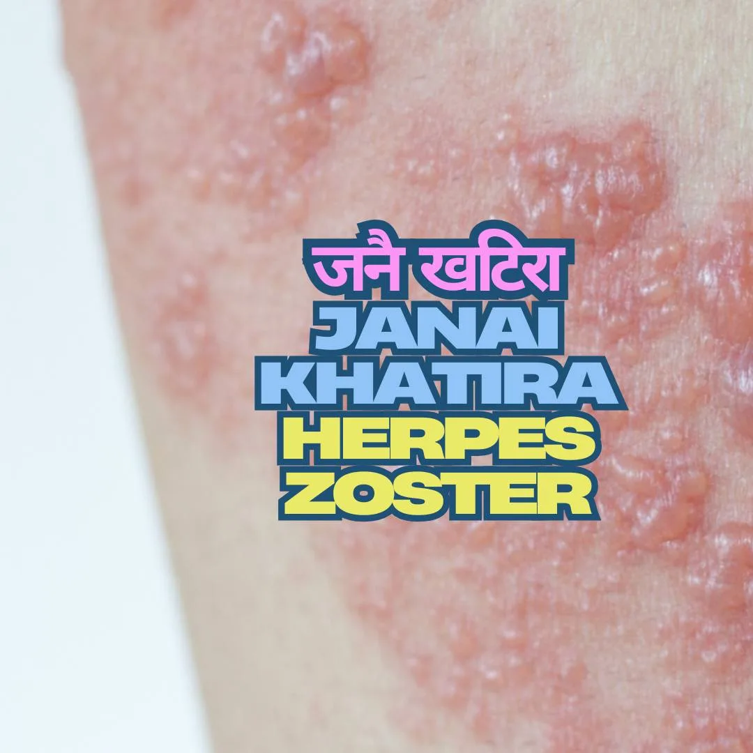 Herpes Zoster - Janai Khatira rash featuring fluid-filled blisters on the skin.
