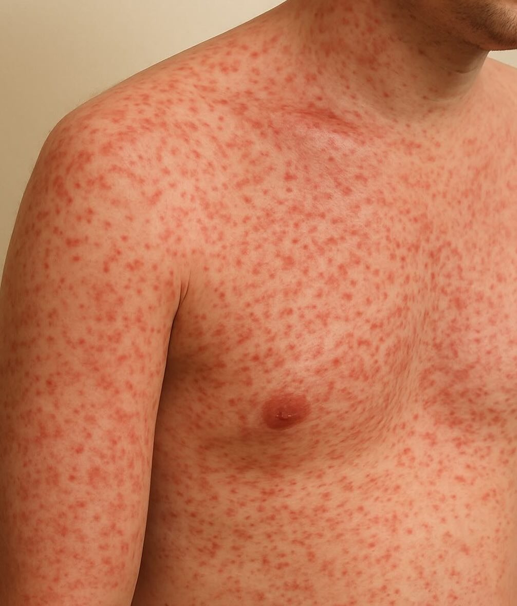 Dengue Rash