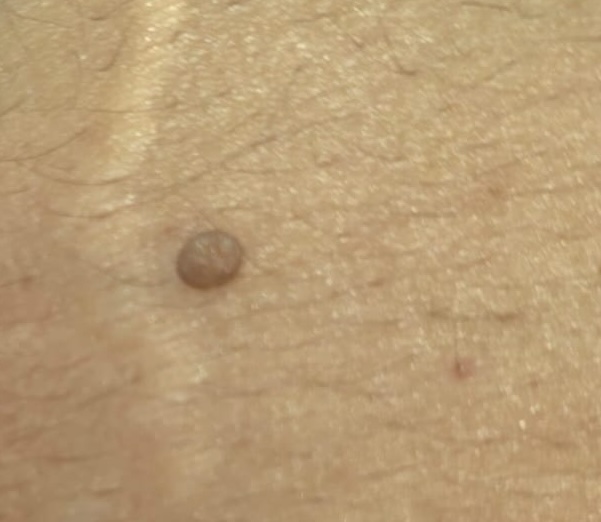 Skin Tags