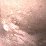 Non-Surgical Vitiligo Treatment in Kathmandu, Nepal