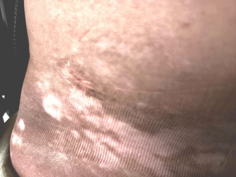 Patient with Vitiligo at Derma Clinic Kathmandu