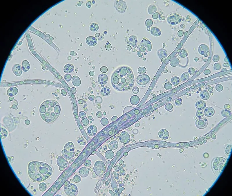 Candida Balanitis - Candida albicans