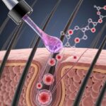 A New Horizon in Hair Restoration: Understanding PP405