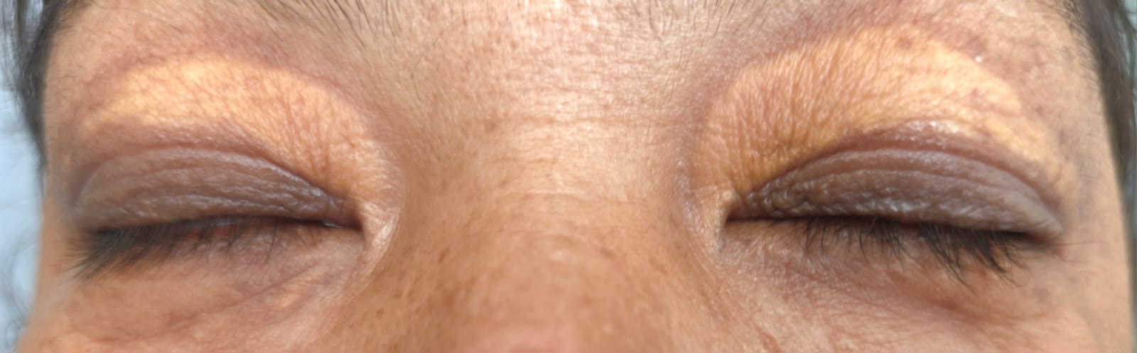 Xanthelasma-Derma Clinic