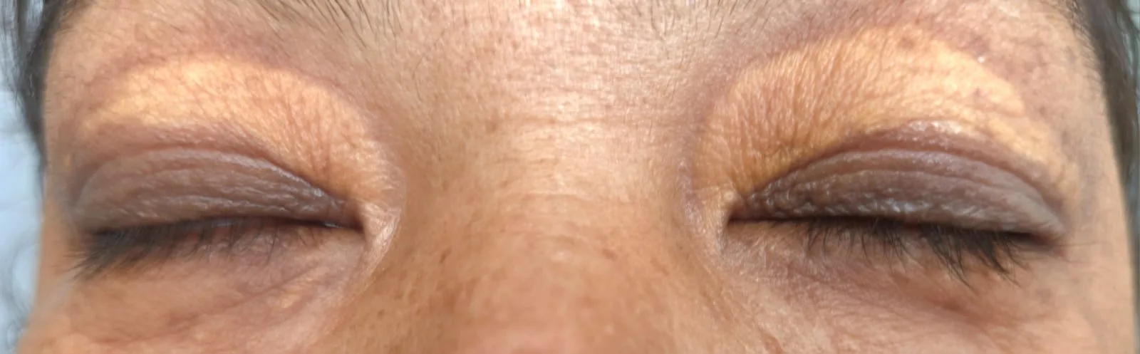 Xanthelasma-Derma Clinic