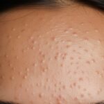 Fungal Acne: How to Know, How It’s Different, and Treatment Options