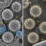 Genital Herpes HSV-1 vs HSV-2: Difference Recurrence, Treatment & Pregnancy Facts