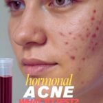 Hormonal Acne Blood Tests in Kathmandu: The Ultimate Guide
