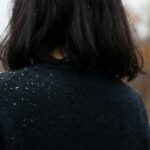 Stop the “Snowfall”: Why Your Dandruff Explodes in Winter (And How to Fix It)