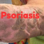 Psoriasis: Causes, Symptoms & Treatment in Derma Clinic Kathmandu