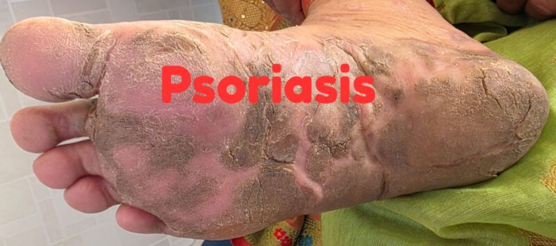 Psoriasis