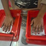 Hyperhidrosis Treatment in Kathmandu | Iontophoresis for Sweaty Palms & Feet