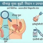 यौनाङ्गमा आउने मुसा (Genital Wart): कारण, लक्षण, आवश्यक जाँच र सफल उपचार