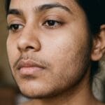 Paradoxical Hypertrichosis After Laser Hair Removal: Causes