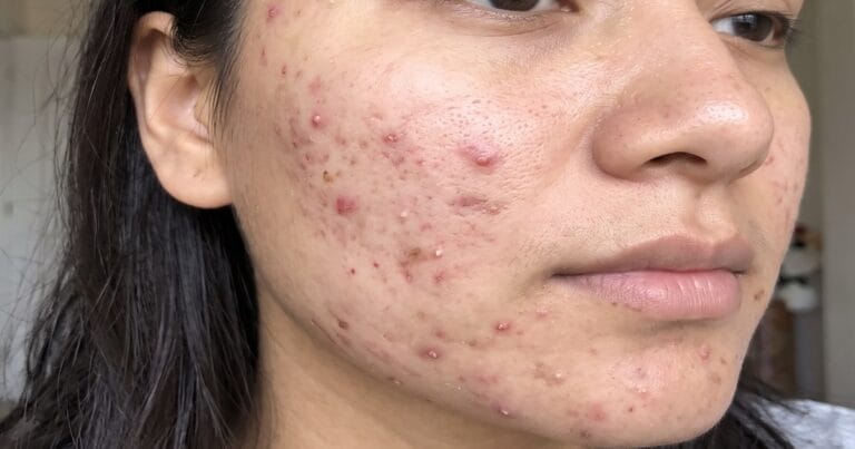 What New Research Reveals About Acne Causes and Future Treatments